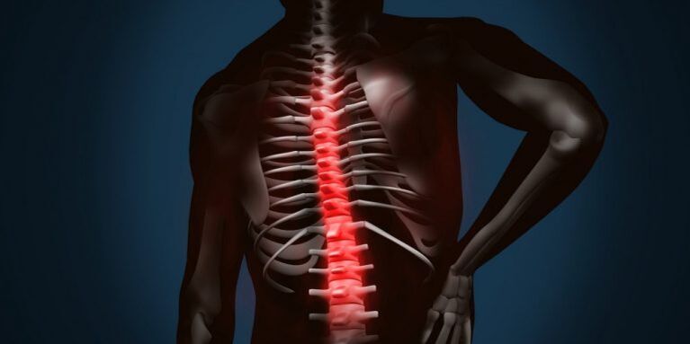 Wirbelsäulenläsionen aufgrund von Osteochondrose